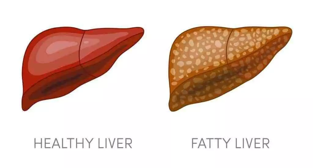 fatty liver guide